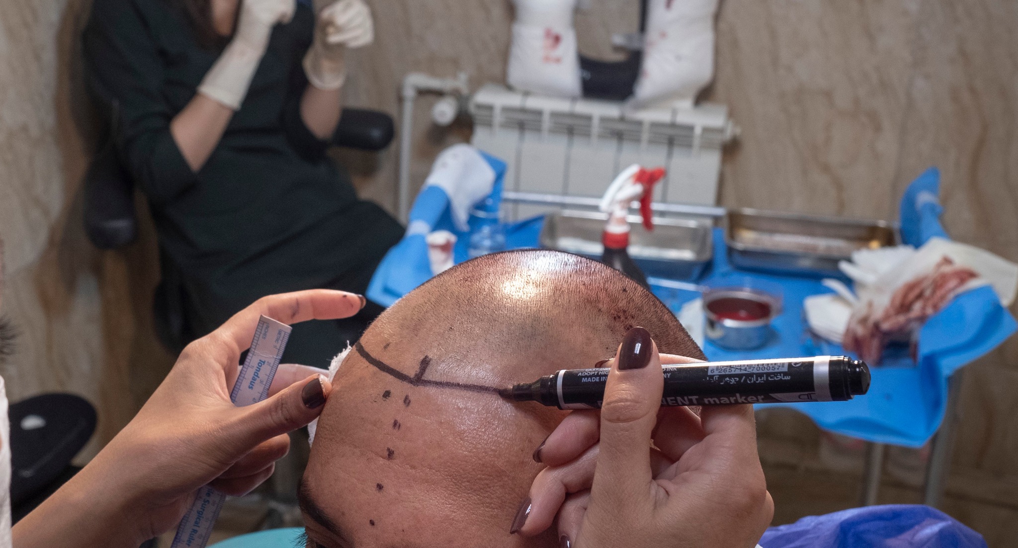 Tragic Hair Transplant Death in Turkey A man died while in the prep phase of his second hair transplant surgery in Turkey. DETAILS: