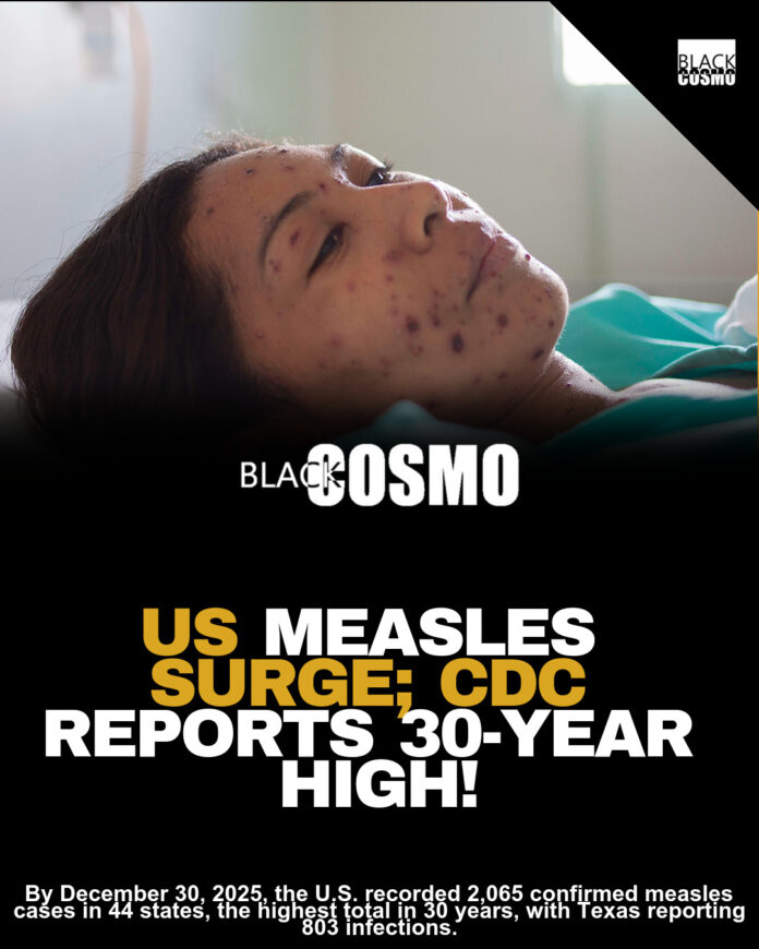 U.S. Ends 2025 With Over 2,065 Confirmed Measles Cases, CDC Says It’s The Highest In 30 Years; Texas, Arizona, South Carolina, Utah Lead With Most Cases U.S. Ends 2025 With Over 2,065 Confirmed Measles Cases, CDC Says It’s The Highest In 30 Years; Texas, Arizona, South Carolina, Utah Lead With Most Cases