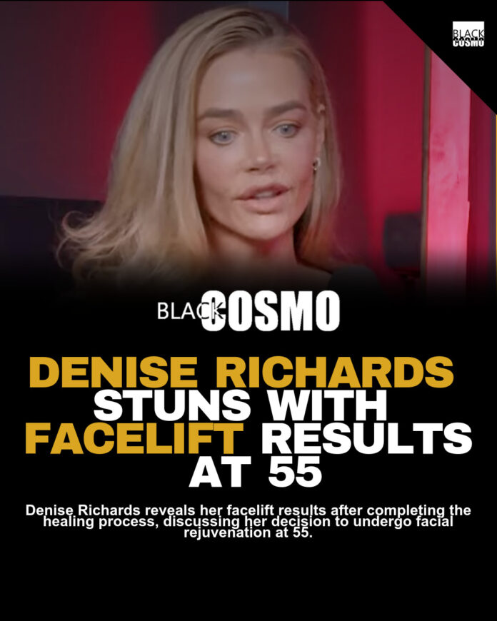 Denise Rich’s Facelift Healed – Looks 10 Years Younger Denise Rich’s Facelift Healed – Looks 10 Years Younger